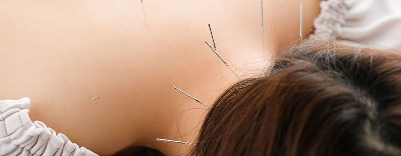 Patient receiving acupuncture in Redmond for auto accident injury pain relief